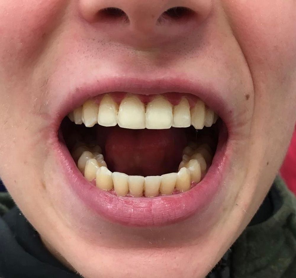 alex-6-month-braces-after